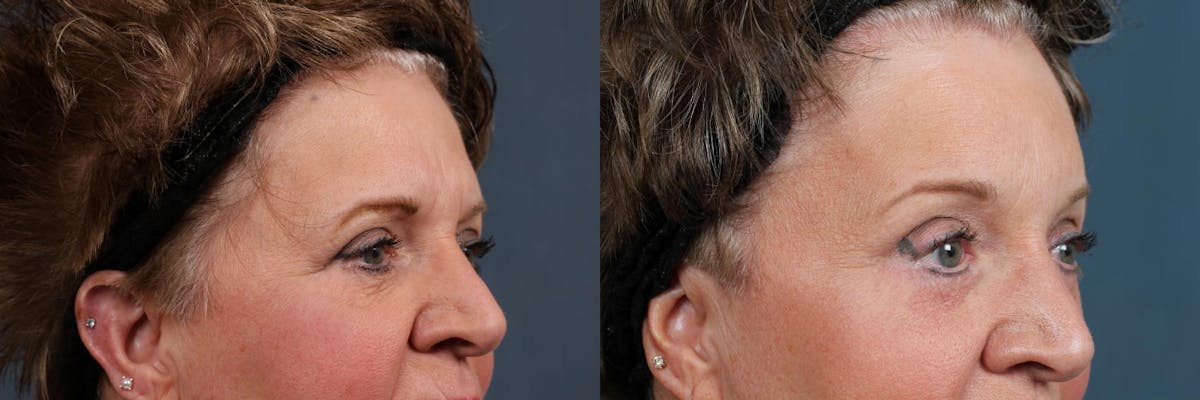 Eyelid Surgery Before & After Gallery - Patient 416206 - Image 3
