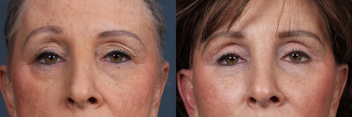 Eyelid Surgery Before & After Gallery - Patient 177916 - Image 1