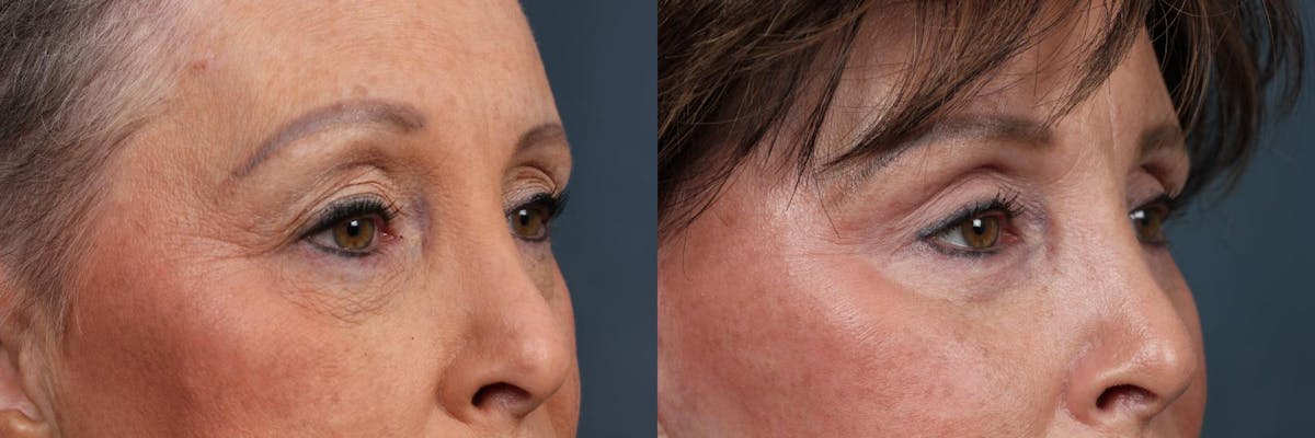 Eyelid Surgery Before & After Gallery - Patient 177916 - Image 2