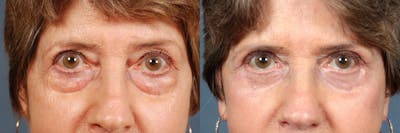 Eyelid Surgery Before & After Gallery - Patient 847476 - Image 1