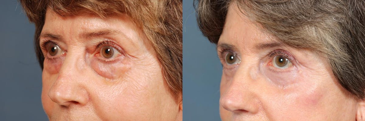 Eyelid Surgery Before & After Gallery - Patient 847476 - Image 2
