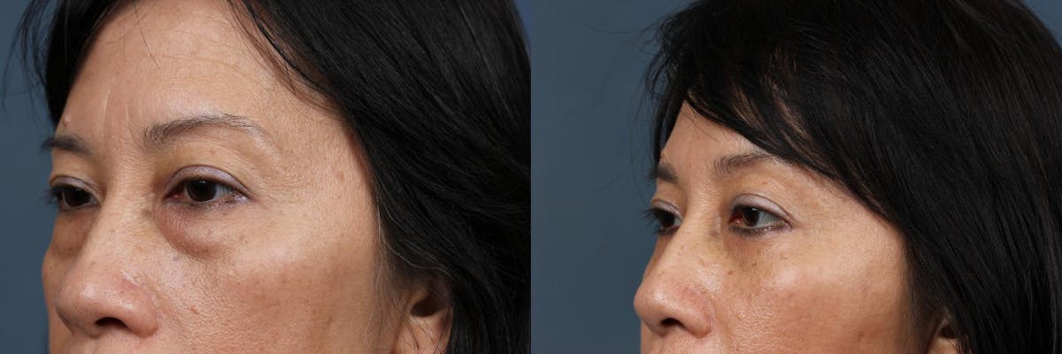 Eyelid Surgery Before & After Gallery - Patient 132159 - Image 2