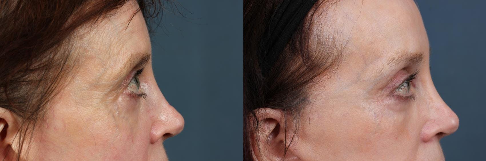 Eyelid Surgery Before & After Gallery - Patient 264011 - Image 3