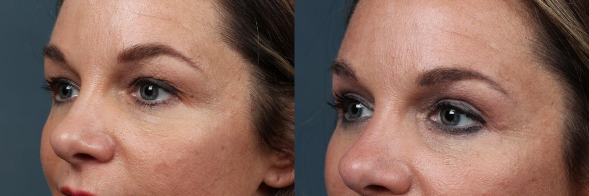 Eyelid Surgery Before & After Gallery - Patient 233520 - Image 2