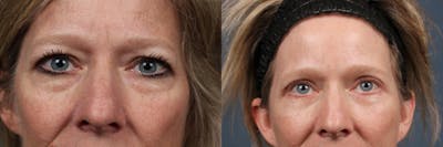 Eyelid Surgery Before & After Gallery - Patient 118819 - Image 1