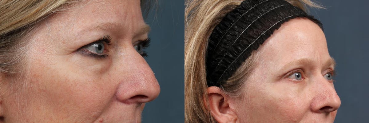 Eyelid Surgery Before & After Gallery - Patient 118819 - Image 2