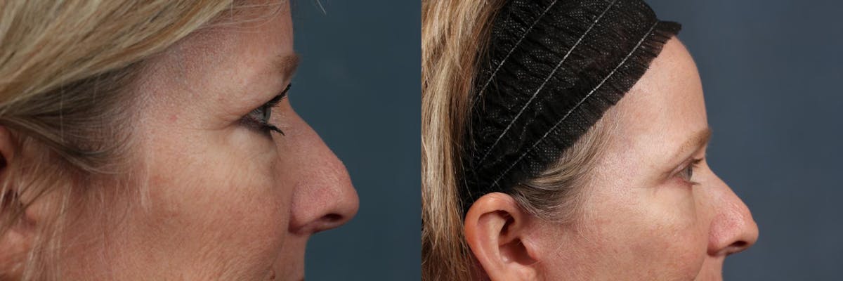 Eyelid Surgery Before & After Gallery - Patient 118819 - Image 3