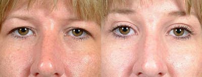 Eyelid Surgery Before & After Gallery - Patient 190173 - Image 1