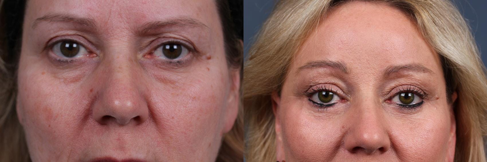 Eyelid Surgery Before & After Gallery - Patient 243845 - Image 1