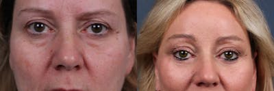Eyelid Surgery Before & After Gallery - Patient 243845 - Image 1