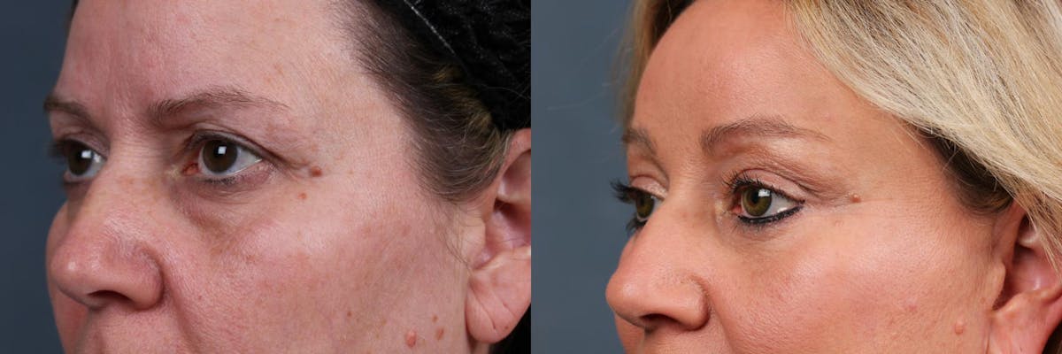 Eyelid Surgery Before & After Gallery - Patient 243845 - Image 2