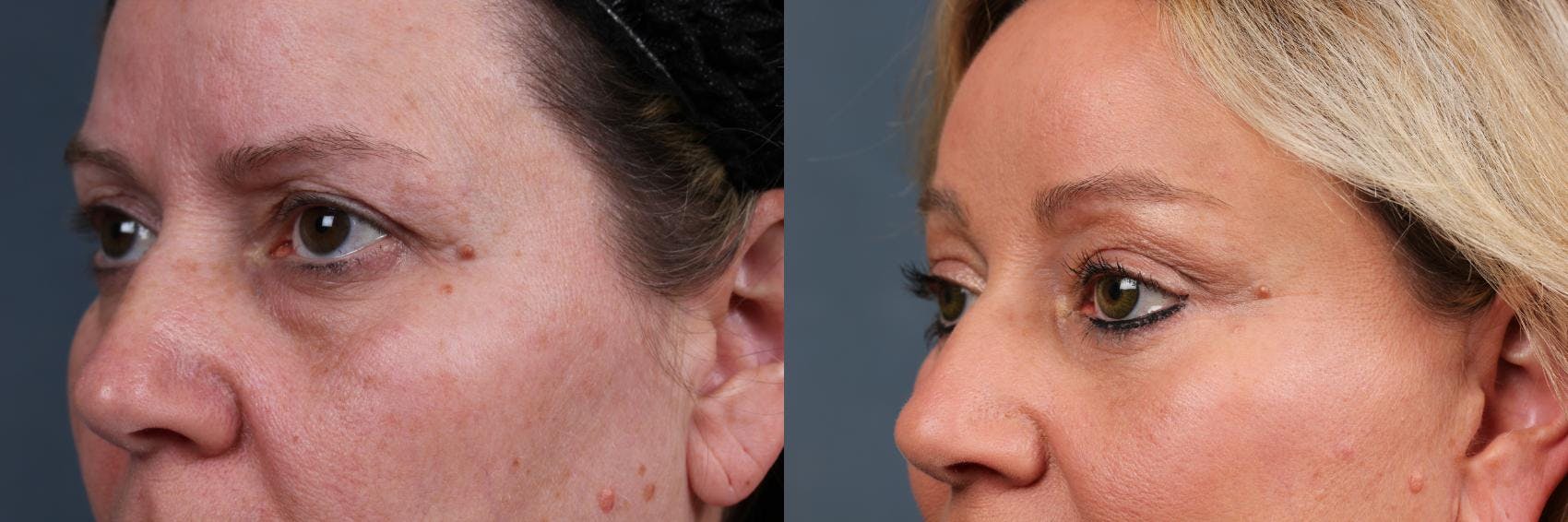 Eyelid Surgery Before & After Gallery - Patient 243845 - Image 2