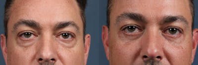 Eyelid Surgery Before & After Gallery - Patient 377694 - Image 1