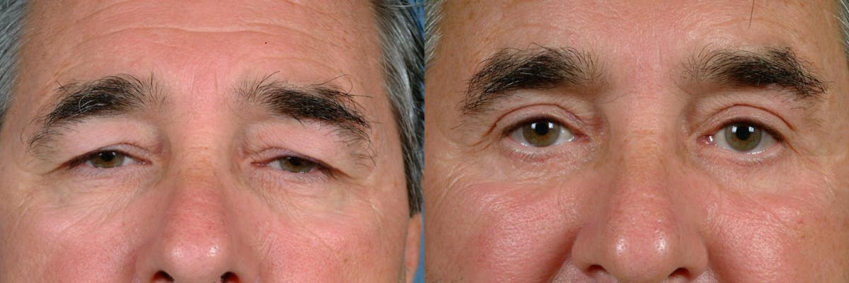 Eyelid Surgery Before & After Gallery - Patient 403983 - Image 1