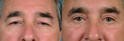 Eyelid Surgery Before & After Gallery - Patient 403983 - Image 1