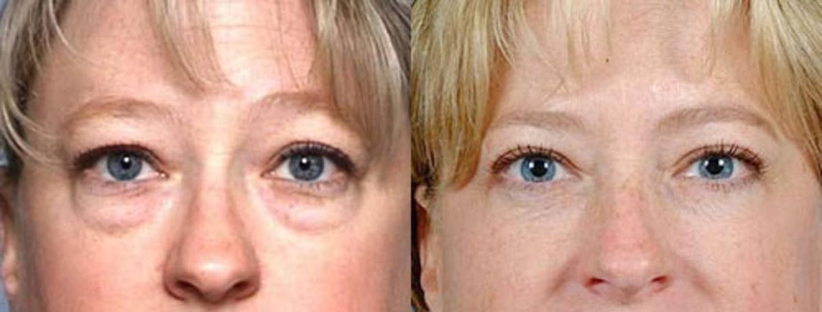 Eyelid Surgery Before & After Gallery - Patient 347014 - Image 1
