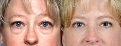 Eyelid Surgery Before & After Gallery - Patient 347014 - Image 1