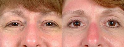 Eyelid Surgery Before & After Gallery - Patient 147591 - Image 1