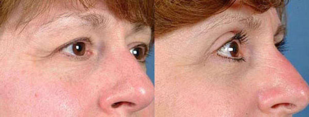 Eyelid Surgery Before & After Gallery - Patient 147591 - Image 2