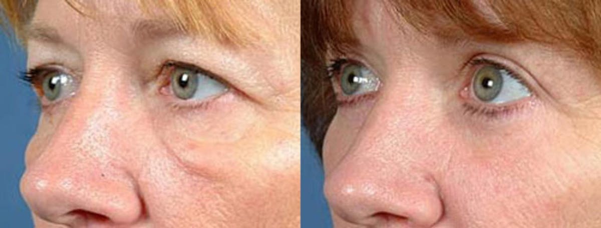 Eyelid Surgery Before & After Gallery - Patient 237731 - Image 2