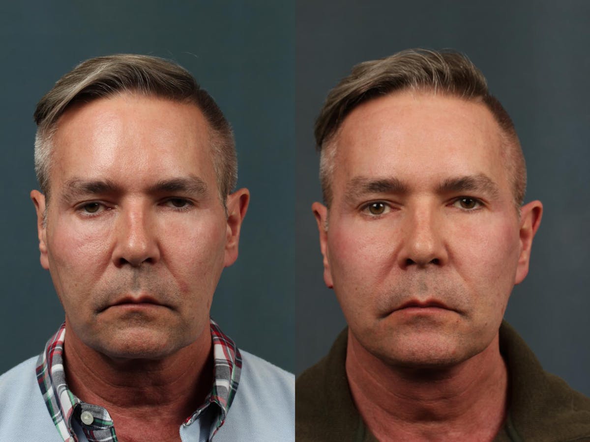 Eyelid Surgery Before & After Gallery - Patient 211323 - Image 1