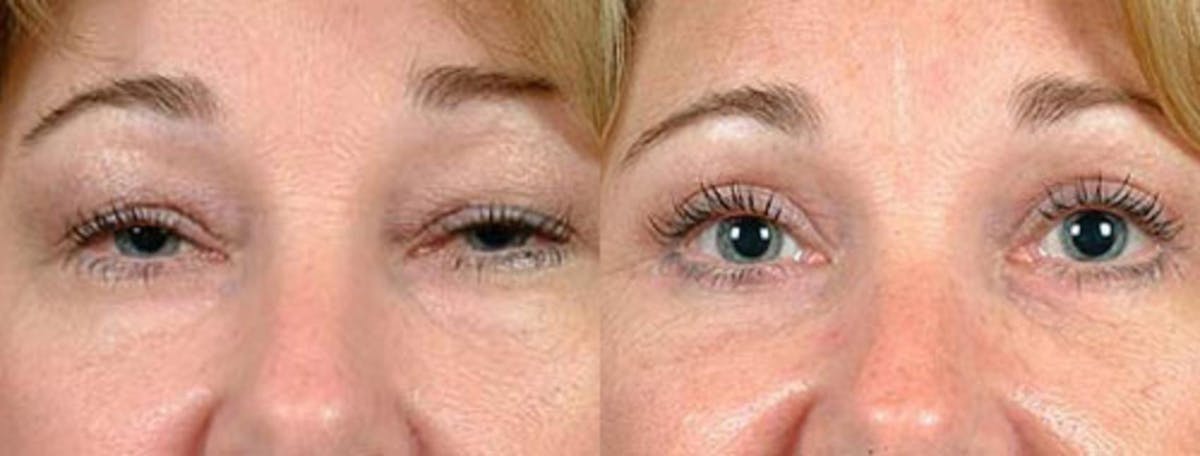 Eyelid Surgery Before & After Gallery - Patient 166031 - Image 1