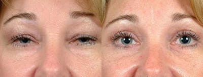 Eyelid Surgery Before & After Gallery - Patient 166031 - Image 1