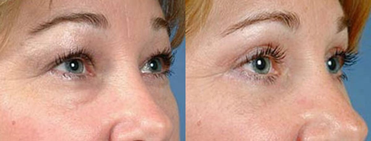 Eyelid Surgery Before & After Gallery - Patient 166031 - Image 2