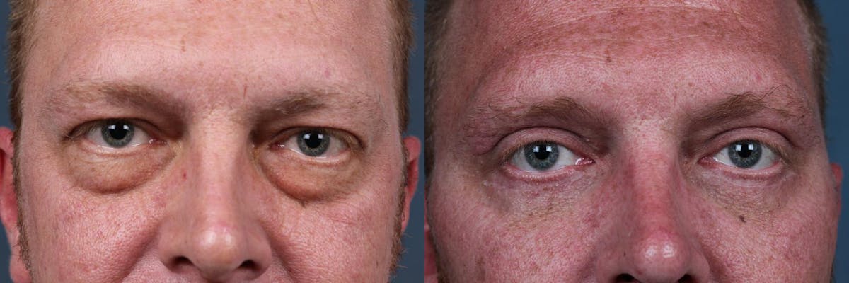 Eyelid Surgery Before & After Gallery - Patient 300232 - Image 1