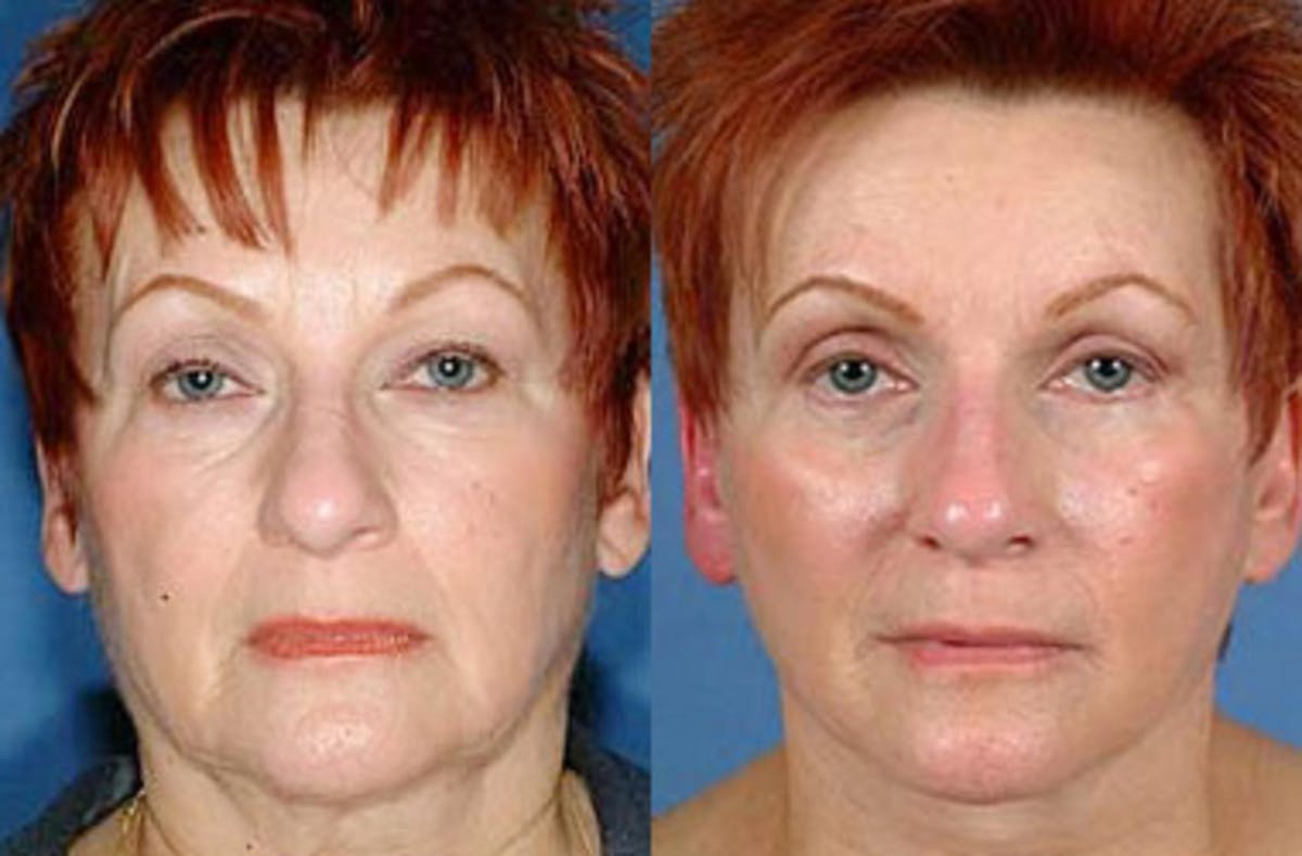 Eyelid Surgery Before & After Gallery - Patient 308835 - Image 1