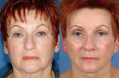 Eyelid Surgery Before & After Gallery - Patient 308835 - Image 1