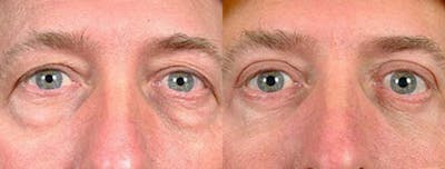 Eyelid Surgery Before & After Gallery - Patient 316608 - Image 1