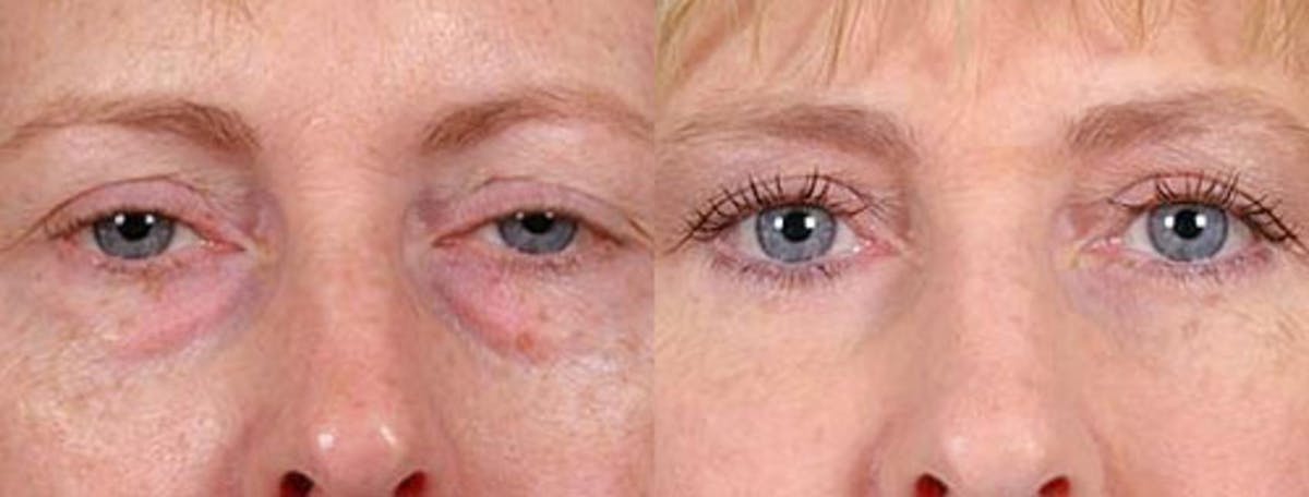 Eyelid Surgery Before & After Gallery - Patient 750388 - Image 1