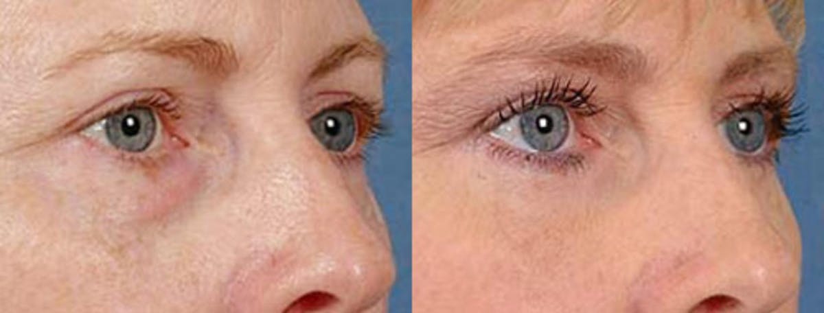 Eyelid Surgery Before & After Gallery - Patient 750388 - Image 2