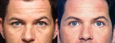 Eyelid Surgery Before & After Gallery - Patient 358861 - Image 1