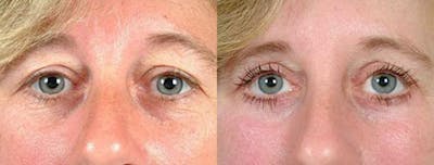 Eyelid Surgery Before & After Gallery - Patient 204663 - Image 1