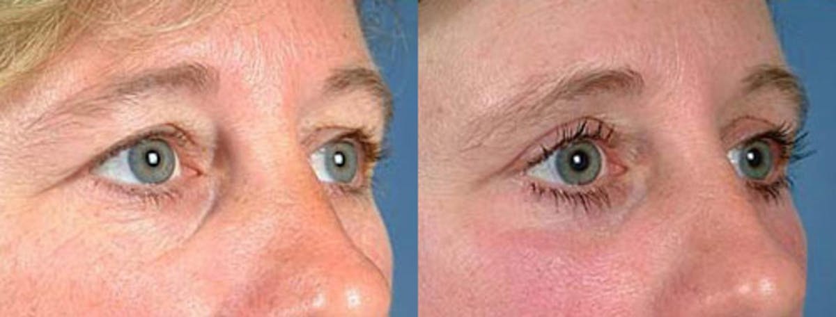 Eyelid Surgery Before & After Gallery - Patient 204663 - Image 2