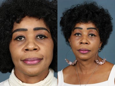 Facelift Before & After Gallery - Patient 422694 - Image 1