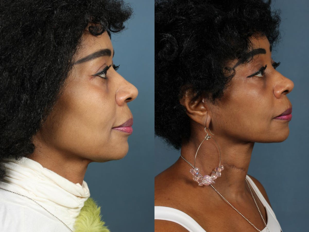 Facelift Before & After Gallery - Patient 422694 - Image 4