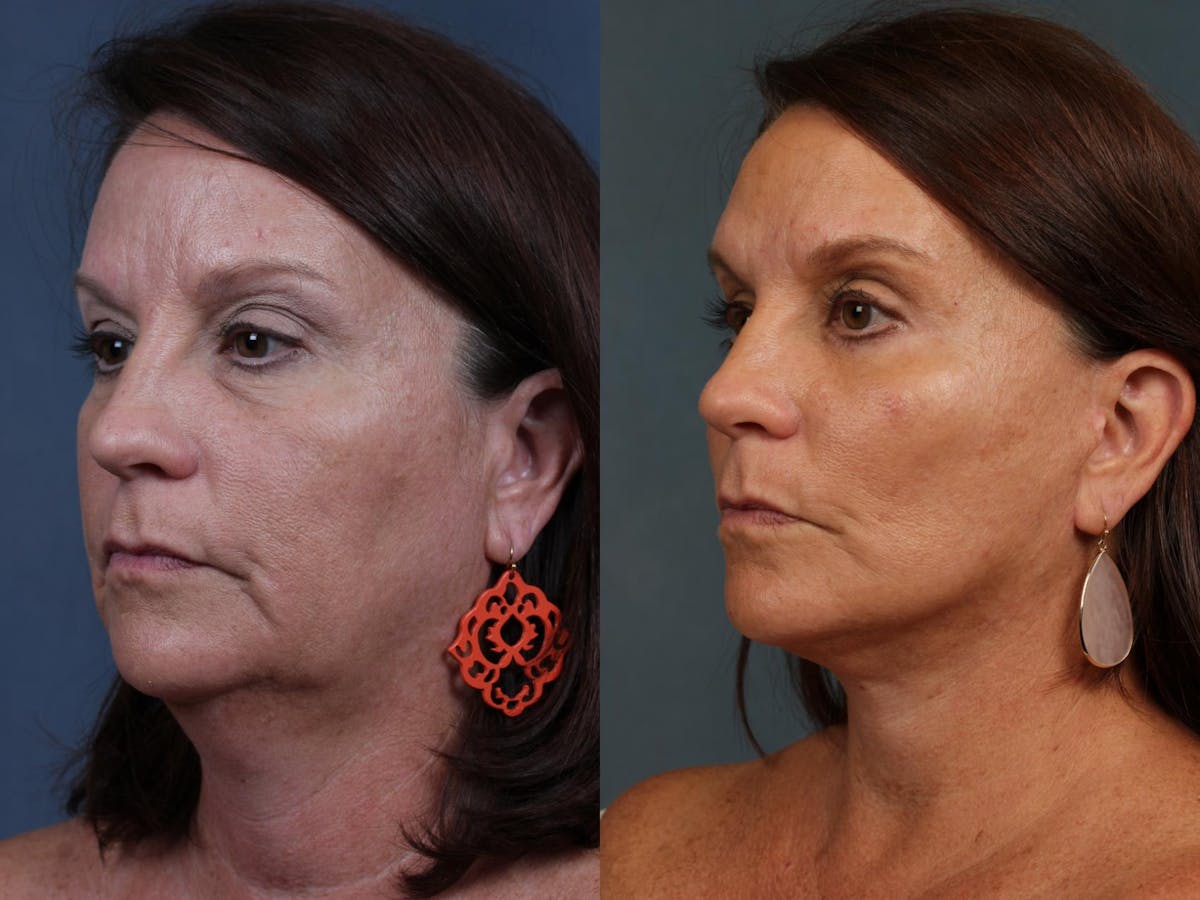 Facelift Before & After Gallery - Patient 164347 - Image 2