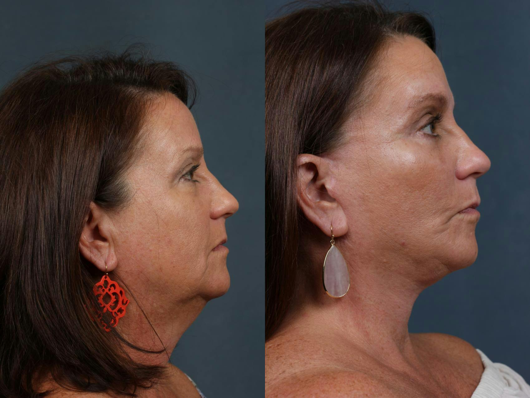 Facelift Before & After Gallery - Patient 164347 - Image 3