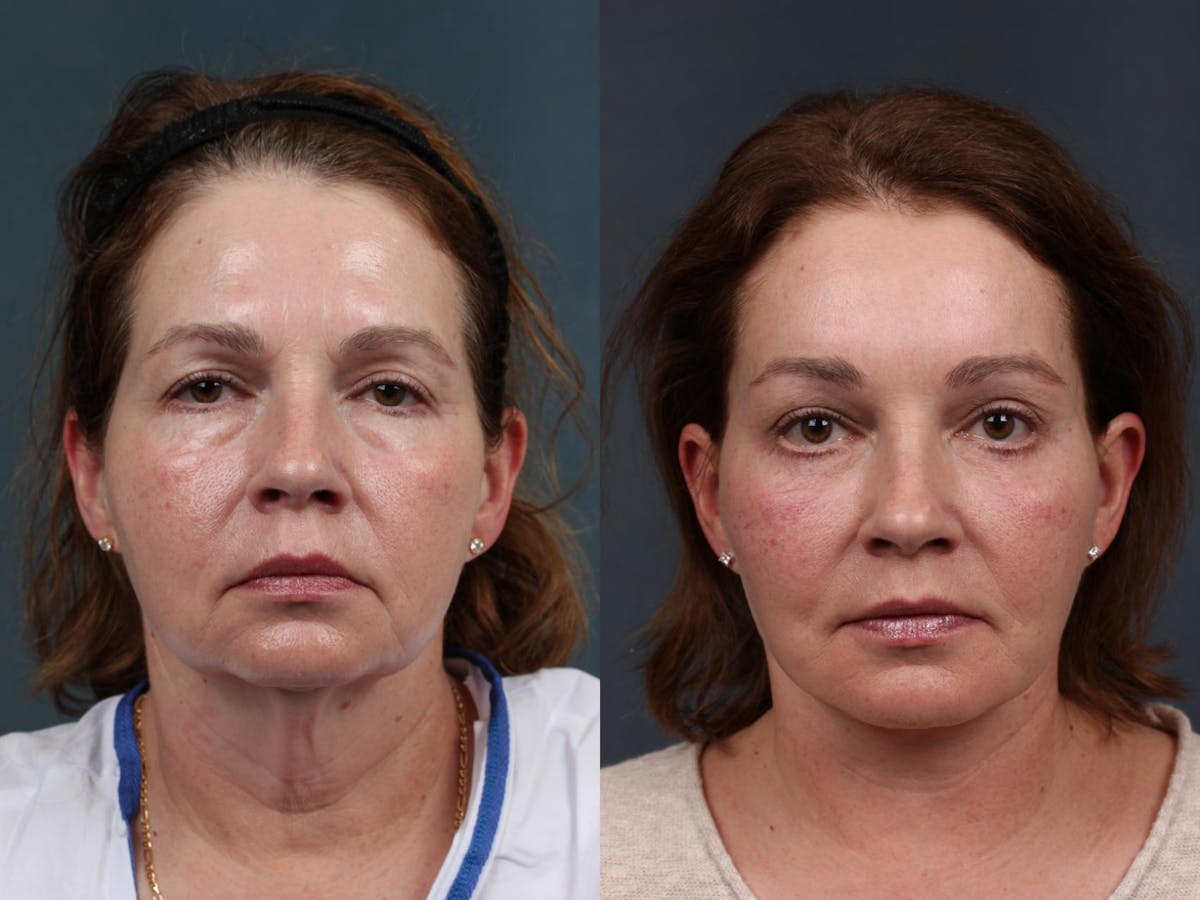 Facelift Before & After Gallery - Patient 923366 - Image 1