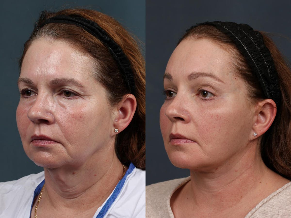 Facelift Before & After Gallery - Patient 923366 - Image 2