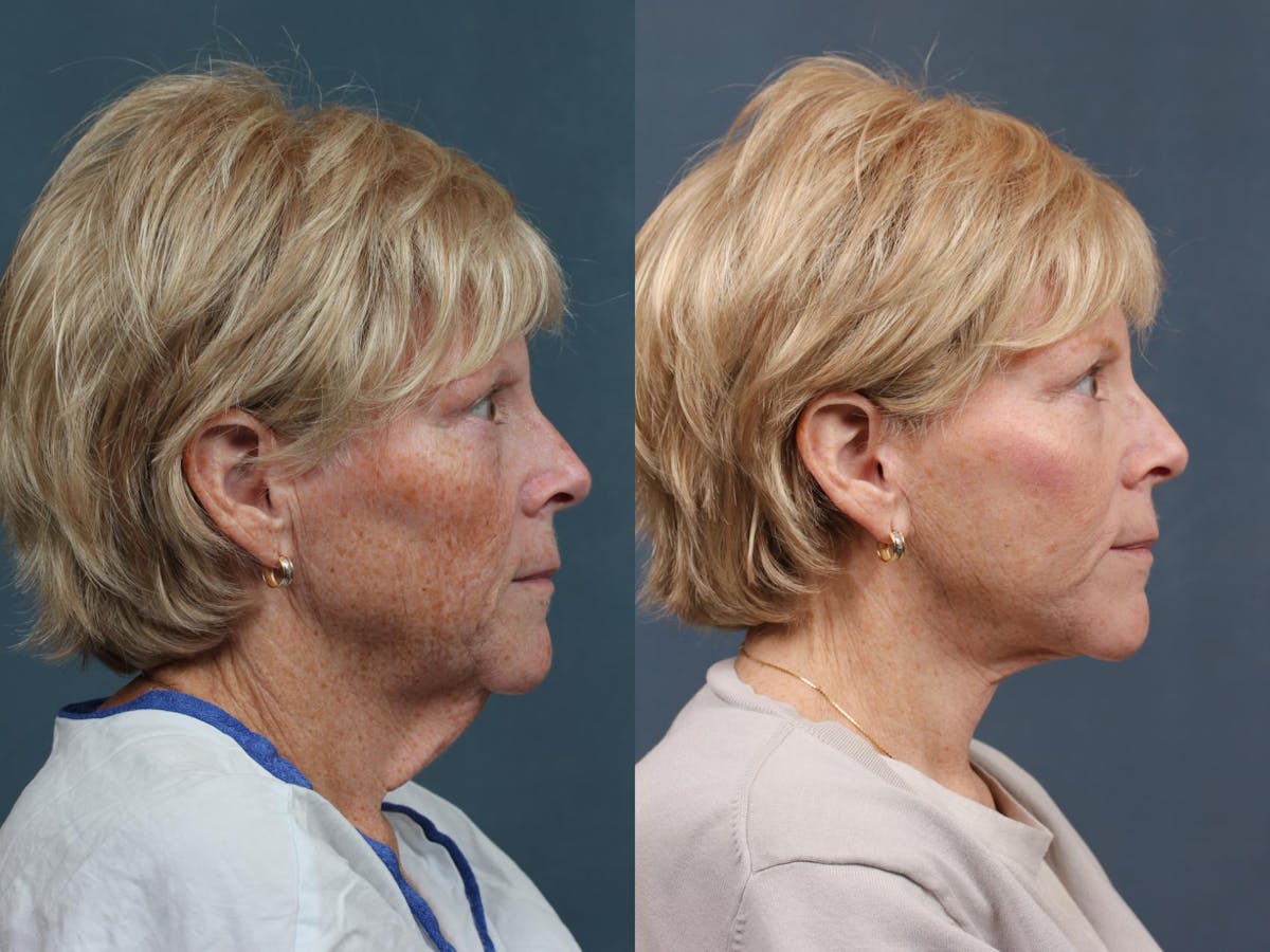 Facelift Before & After Gallery - Patient 344220 - Image 5