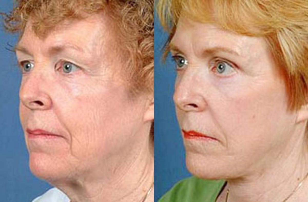 Facelift Before & After Gallery - Patient 127245 - Image 2