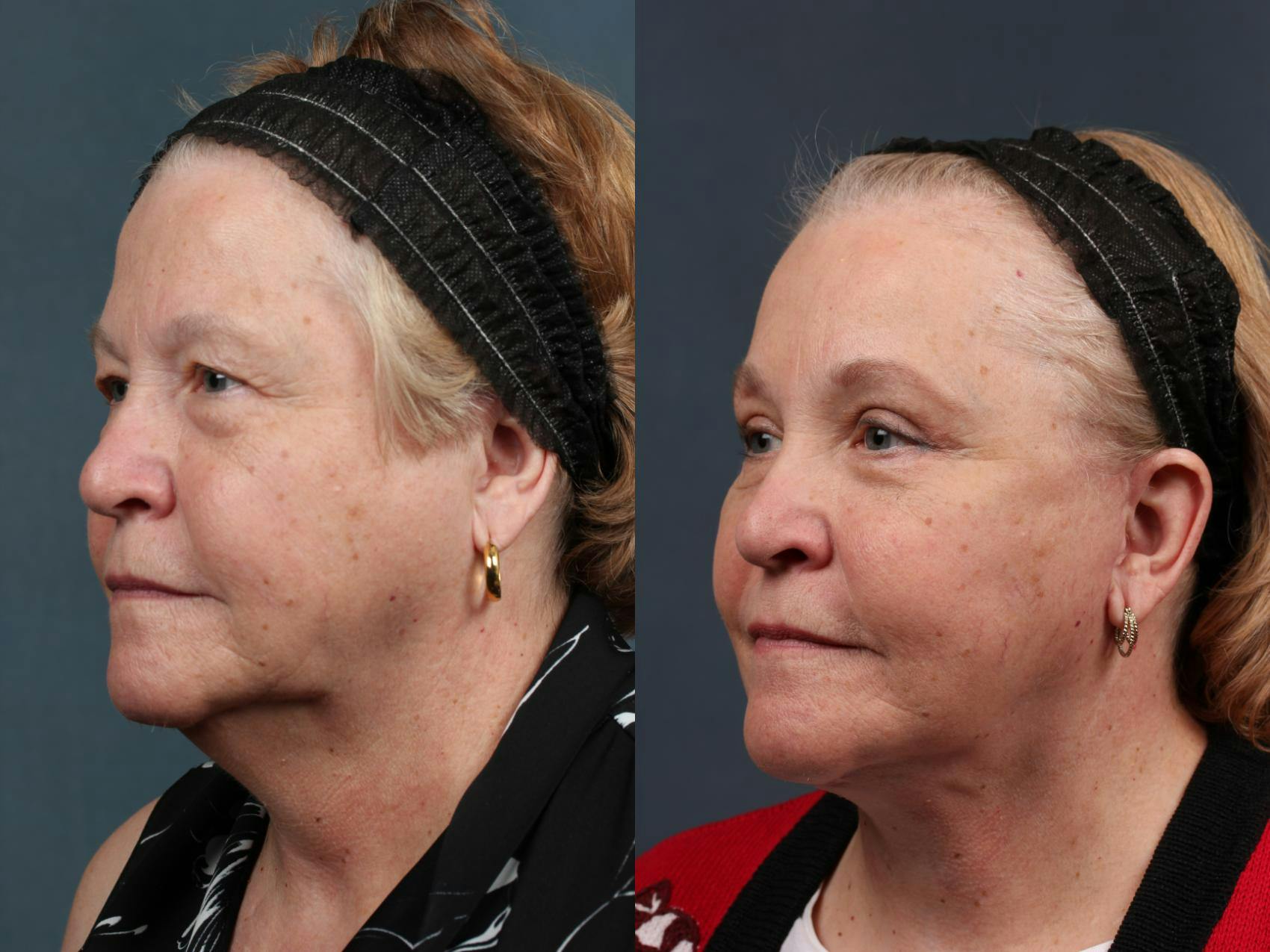 Facelift Before & After Gallery - Patient 176692 - Image 2
