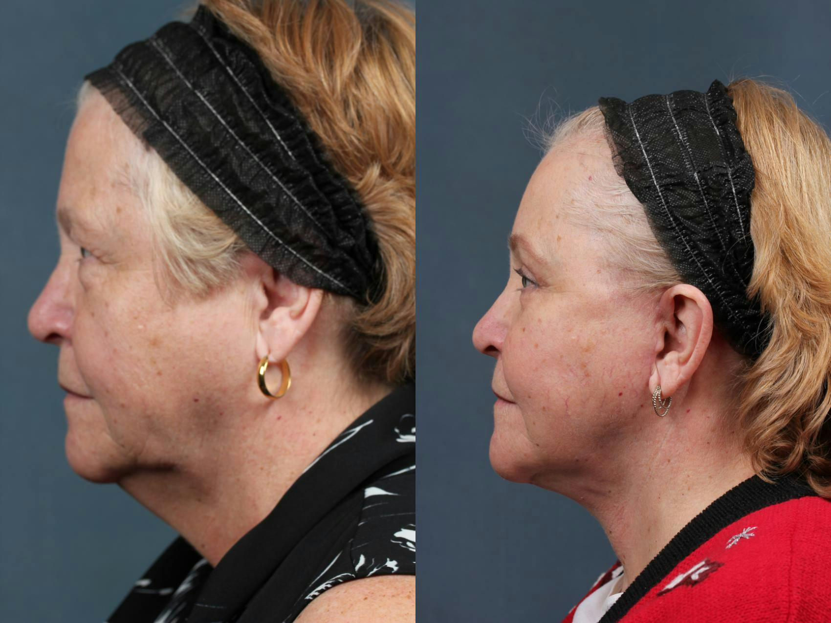 Facelift Before & After Gallery - Patient 176692 - Image 3