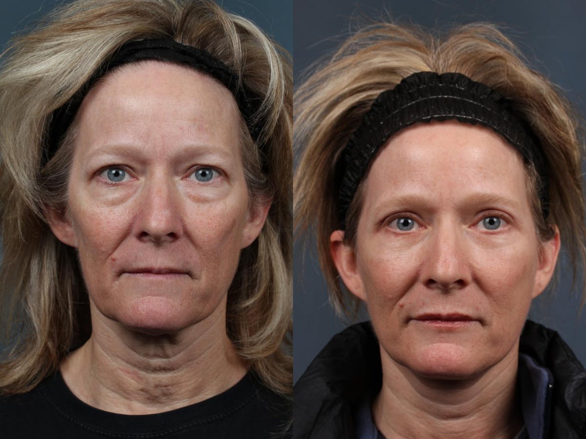 Facelift Before & After Gallery - Patient 151858 - Image 1