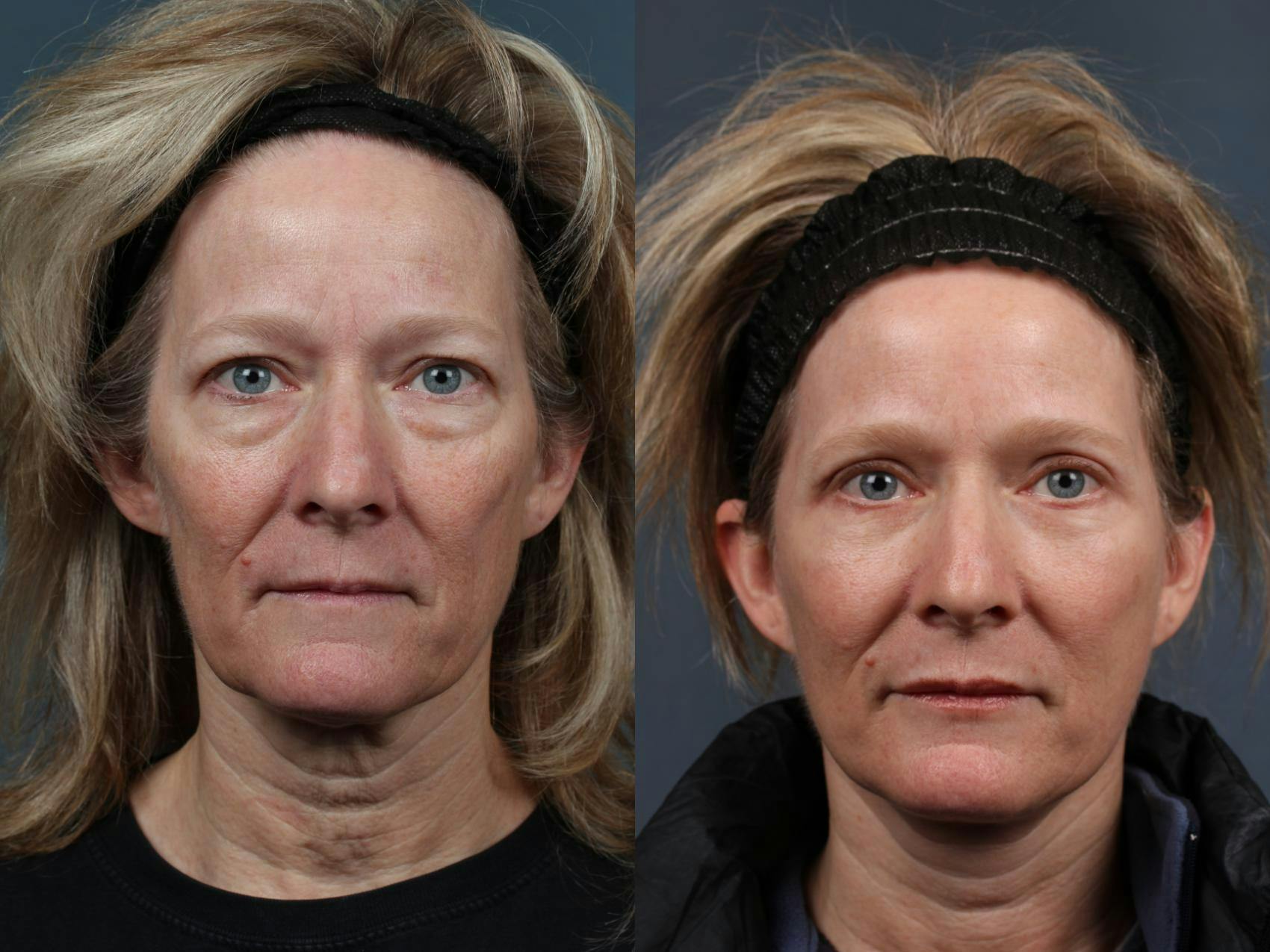 Facelift Before & After Gallery - Patient 151858 - Image 1