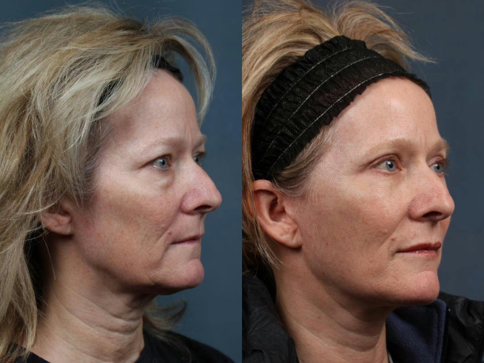 Facelift Before & After Gallery - Patient 151858 - Image 2